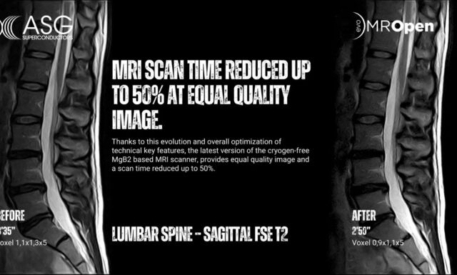 MROPEN EVO AT RSNA24: MRI SCAN TIME REDUCED UP TO 50% AT EQUAL QUALITY IMAGE.

Unlocking the future of joint and spine imaging with the latest evolution of MROpen EVO, the only truly open MRI system at RSNA24.

Discover the new features of MROpen EVO — a revolutionary MRI system specifically designed for joints, neuro and spine imaging and able to comfortably welcome children, larger and claustrophobic patients.
MROpen EVO has been enhanced with a faster acquisition imaging. Thanks to this evolution and the overall optimization of several technical key features - all FDA approved - the latest version of the Helium-free MgB2 based MRI scanner, provides equal quality image and a scan time reduced up to 50%.
.
.
.
#rsna #mri #MROpenEVO